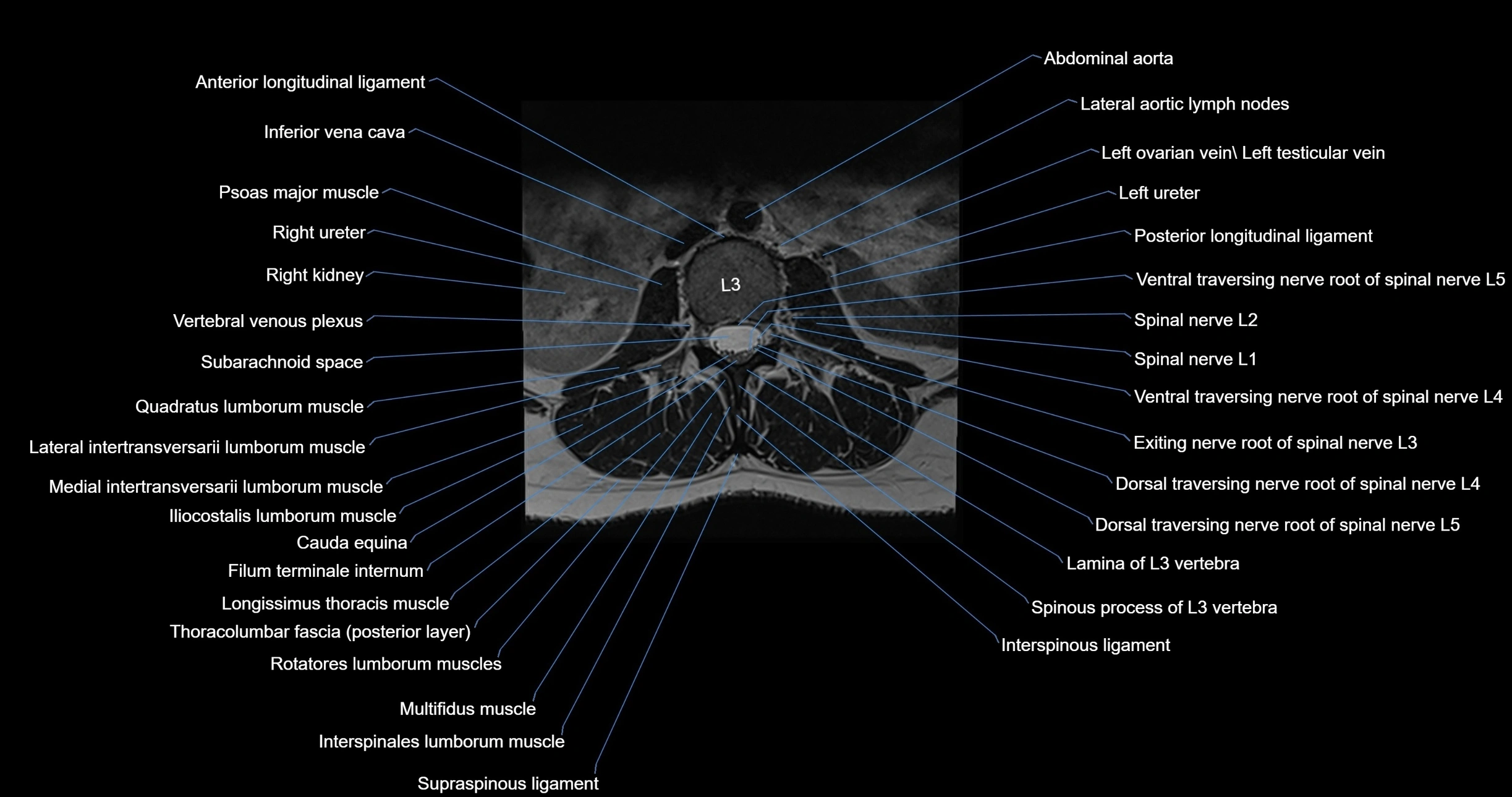 MRI lumbar spine axial cross sectional anatomy 3T radiology  image-img-00001-00023.webp
